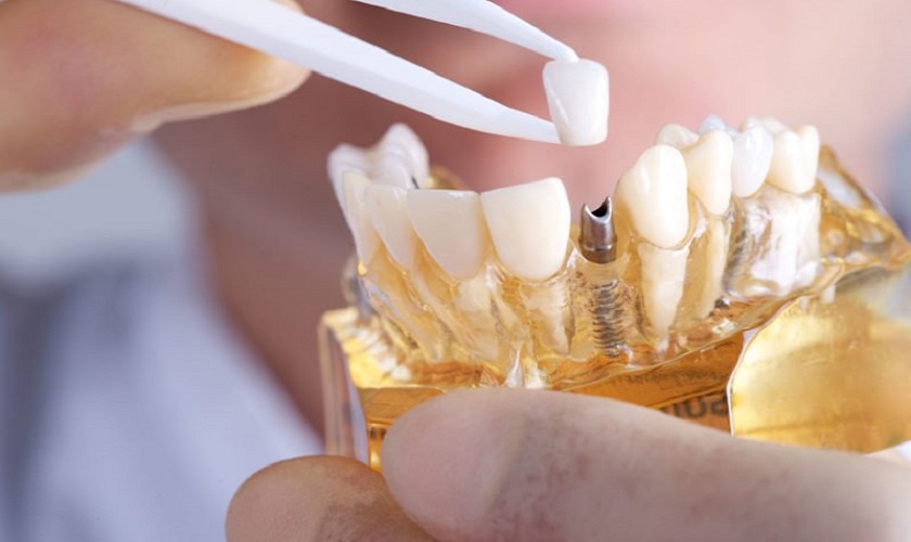 Phục hình răng sứ trên Implant và những điều cần biết