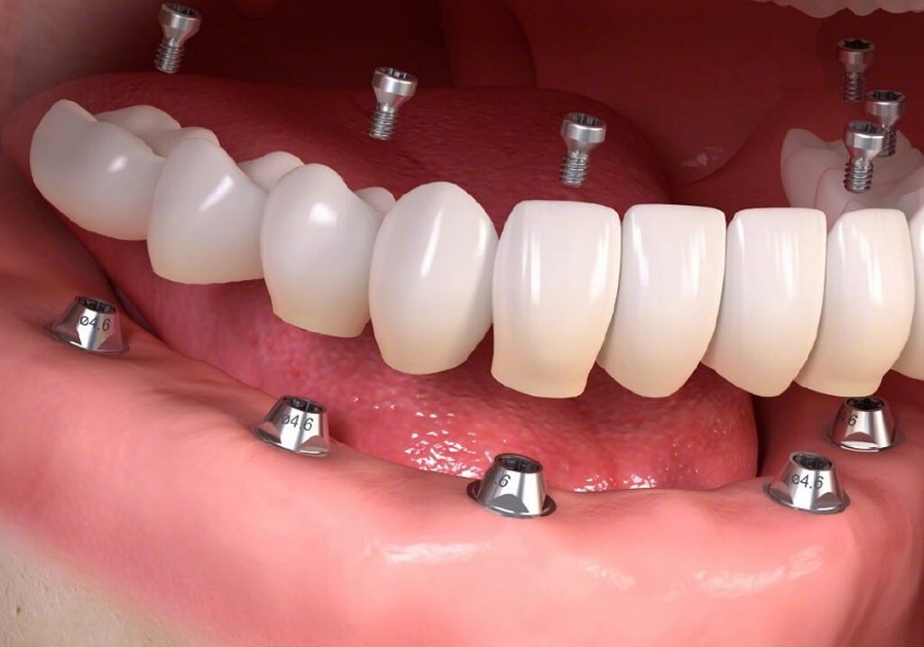 Phương pháp trồng răng Implant Multi