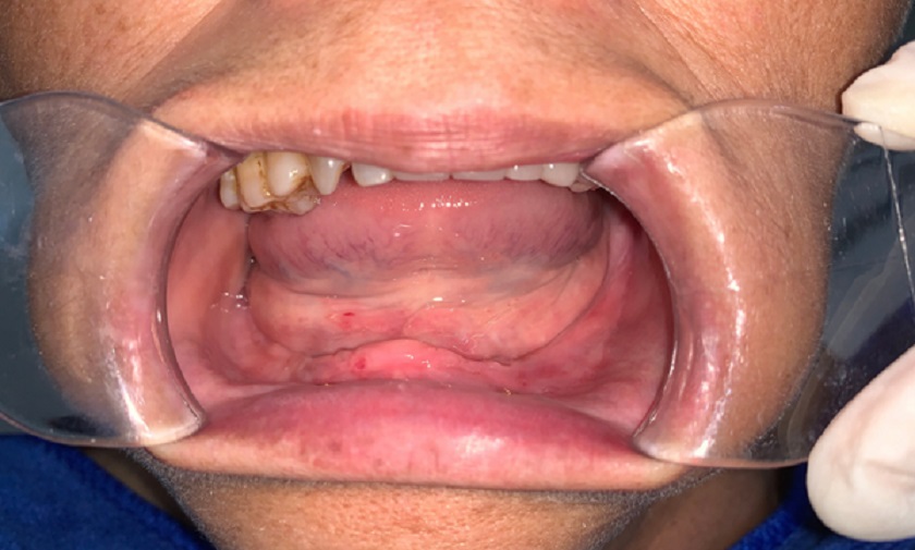 Cấy ghép răng Implant Multi thích hợp với người bị mất răng toàn hàm