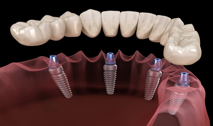 Tìm hiểu về phương pháp trồng răng Implant Multi