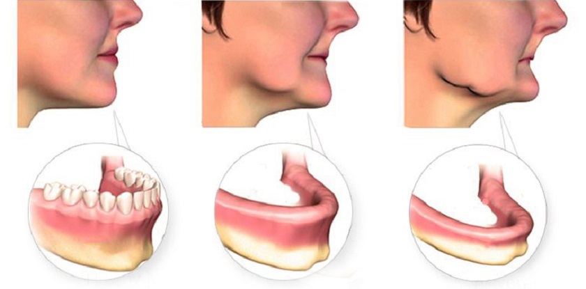 Tiêu xương hàm sau thời gian dài mất răng