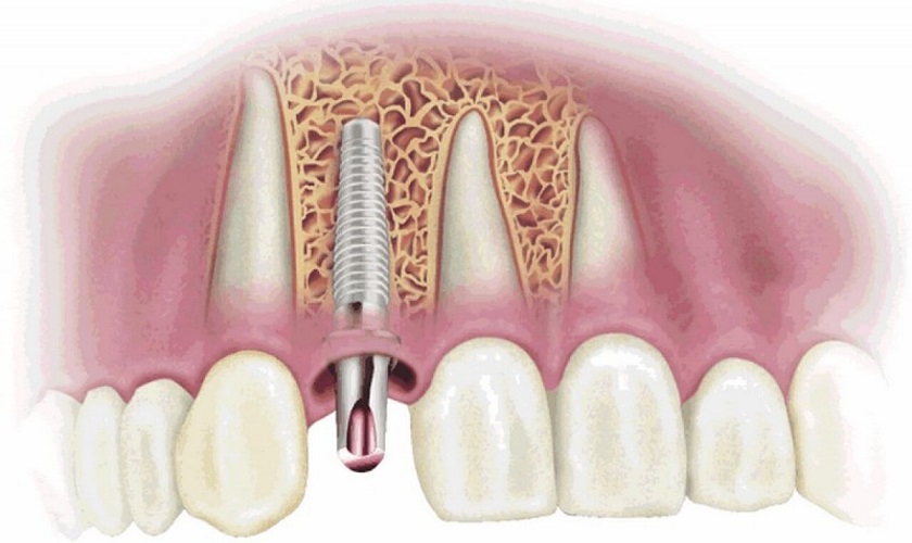 Cần khoảng 3 – 6 tháng để Implant tích hợp hoàn toàn với xương hàm
