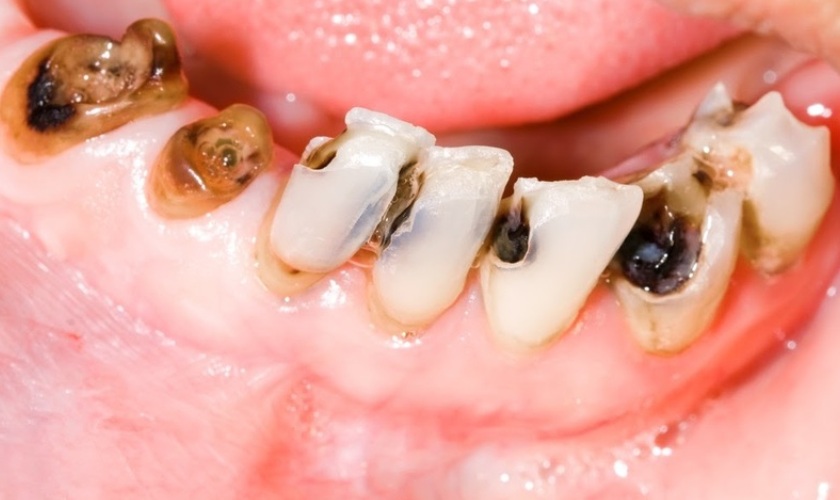 Sâu răng là nguyên nhân gây vết đen trên răng