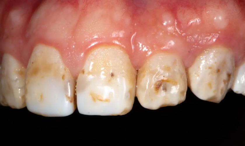 Răng có những vết đen cũng có thể do yếu tố di truyền