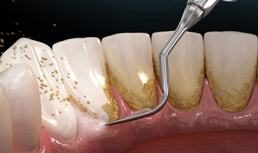 Cạo vôi răng là phương pháp loại bỏ những vết đen do mảng bám vôi răng gây ra