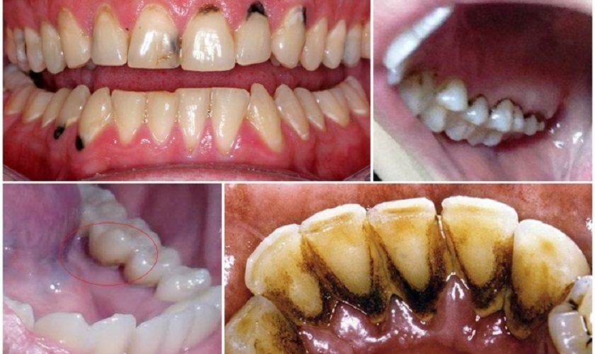 Răng có những vết đen - Nguyên nhân do đâu?