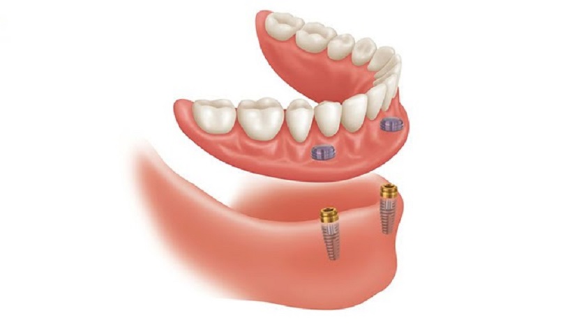 Răng giả tháo lắp không có thanh bar trên Implant