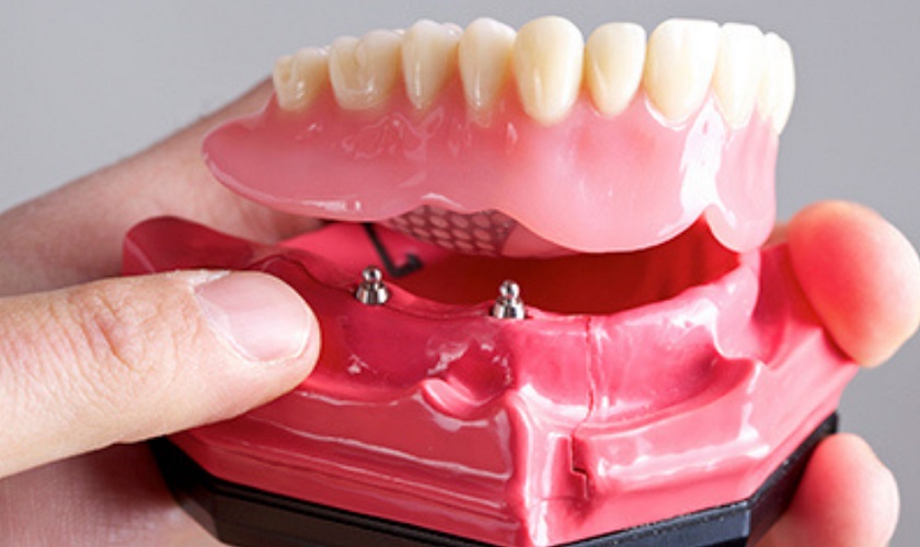 Những điều cần biết về răng giả tháo lắp trên Implant