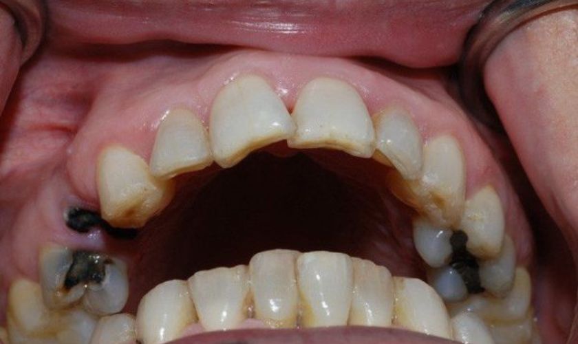 Răng hàm có vết đen gây tác động xấu đến sức khỏe răng miệng