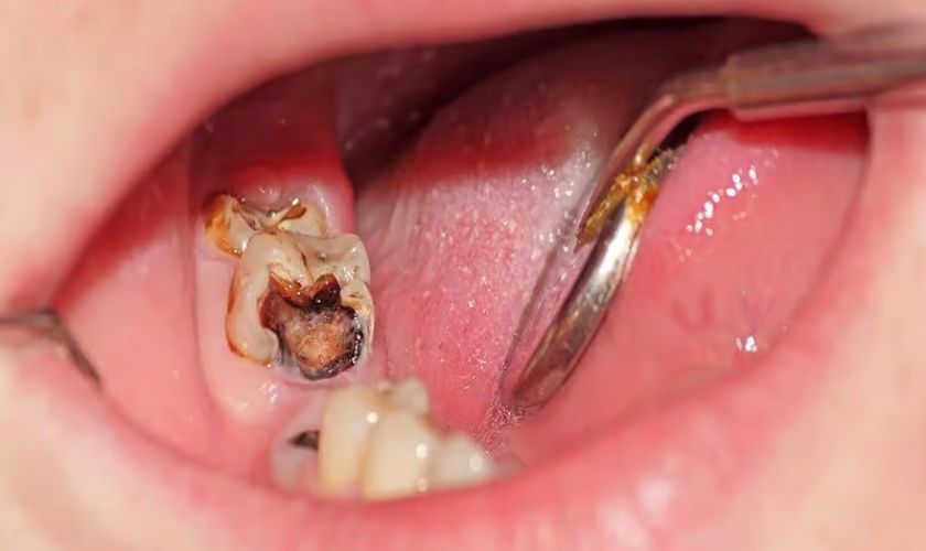 Sâu răng là nguyên nhân chính dẫn đến răng hàm có vết đen