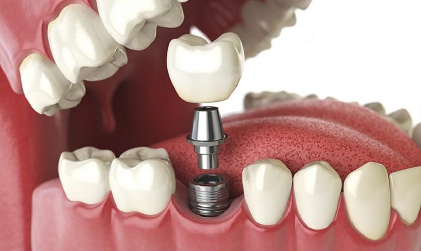 Phục hình răng sứ trên Implant