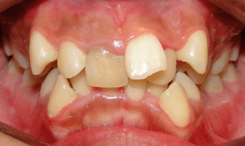 Hình ảnh hàm răng trong một trường hợp răng mọc chồi