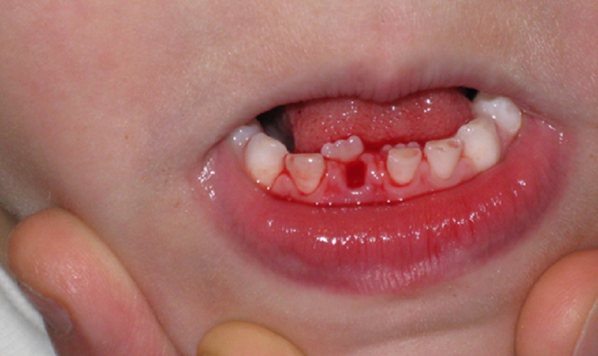 Quá trình mọc răng, rụng răng sữa không bình thường có thế dẫn đến tình trạng răng mọc lẫy