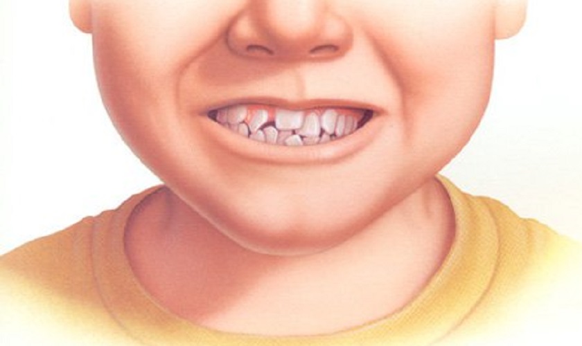 Răng mọc chồi là gì? Hệ quả và giải pháp xử lý cho răng mọc chồi