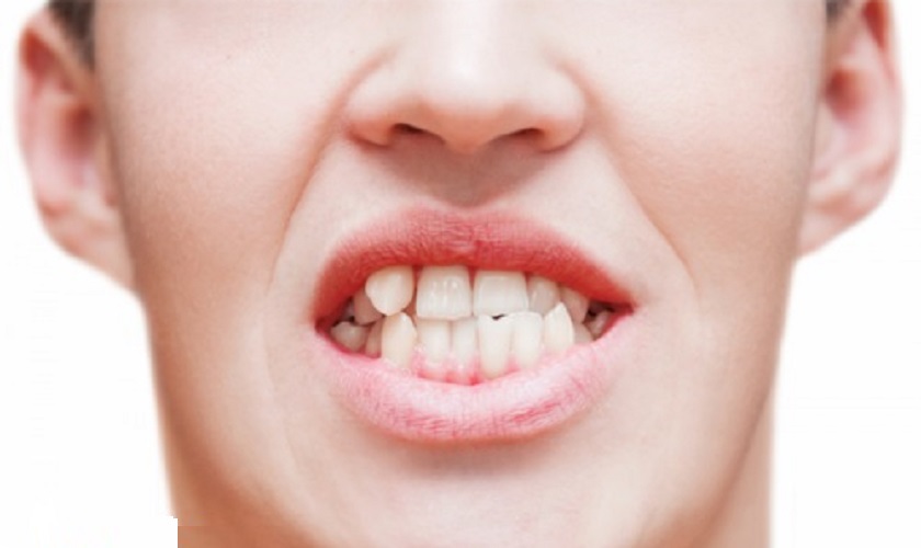 Nguyên nhân bẩm sinh tình trạng răng mộc chồi