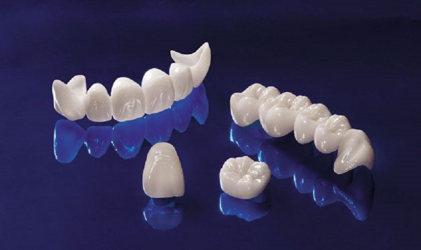 Răng sứ Cercon – Sản phẩm răng toàn sứ chất lượng vượt trội