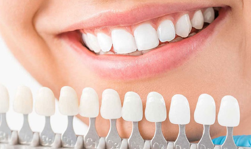 Răng sứ Cercon là gì? Những ưu điểm của răng sứ Cercon