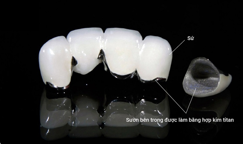 Răng sứ kim loại có phần khung sườn được chế tác từ hợp chất kim loại