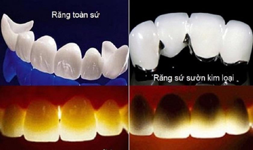 Tính thẩm mỹ của răng sứ kim loại và răng toàn sứ khi có ánh sáng đi qua