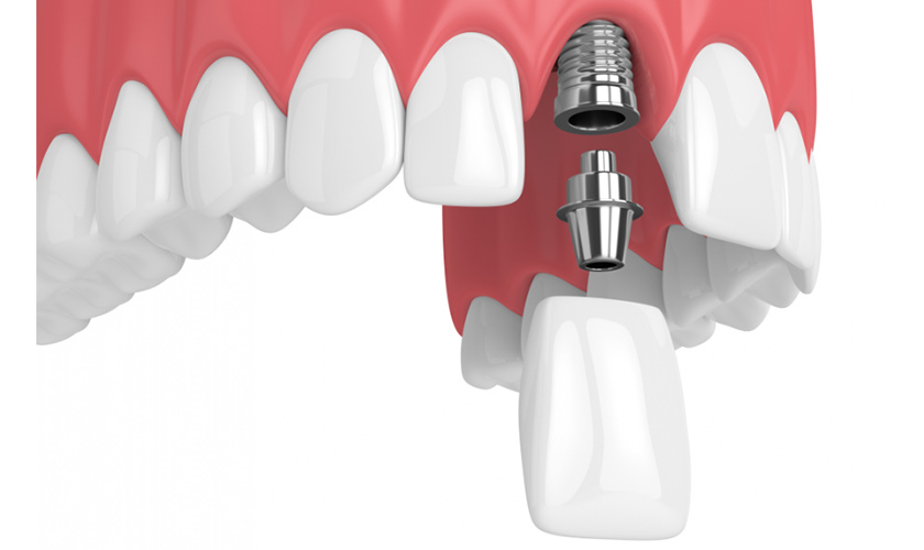 Răng sứ trên Implant có thay mới được không?