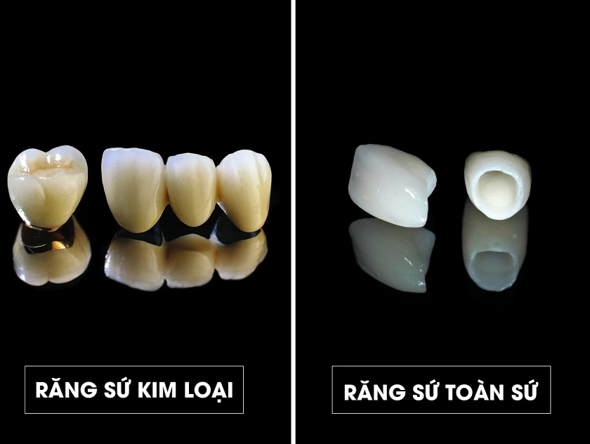 Răng toàn sứ sẽ có giá cao hơn răng sứ kim loại