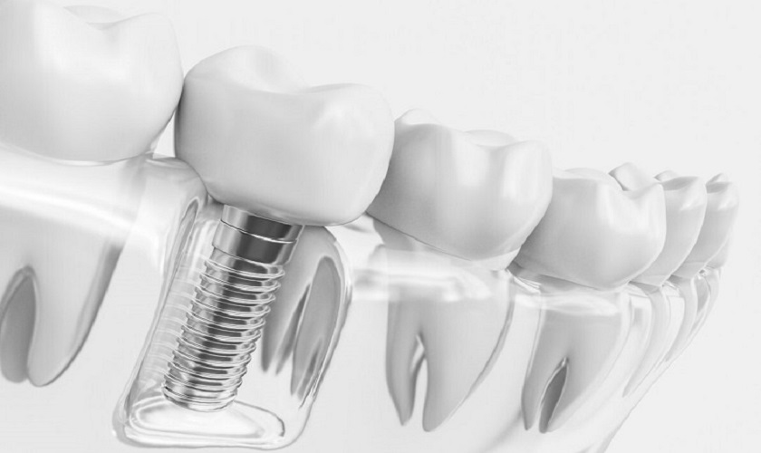 Rủi ro khi trồng răng Implant mà bạn cần biết
