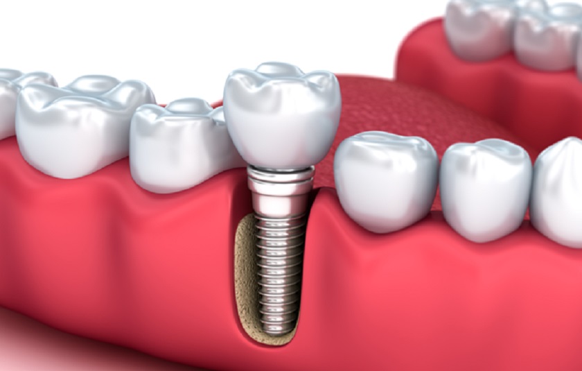 Cấy ghép răng Implant là phương pháp phục hình duy nhất ngăn chặn được biến chứng tiêu xương