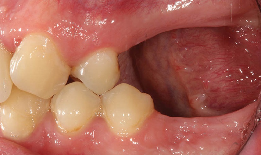 Tư vấn sau nhổ răng bao lâu thì tiêu xương và cách khắc phục