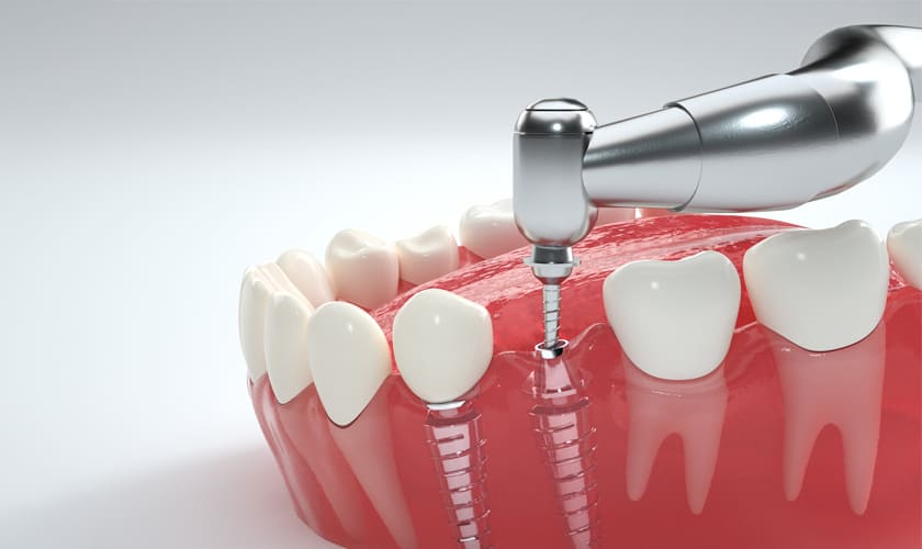 Khi cắm trụ răng implant bệnh nhân sẽ được gây tê cục bộ nên không có cảm giác đau