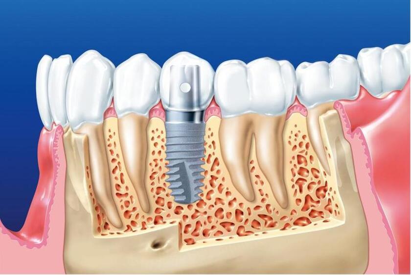 Cấy ghép implant sử dụng trụ implant để thay thế cho chân răng thật đã mất
