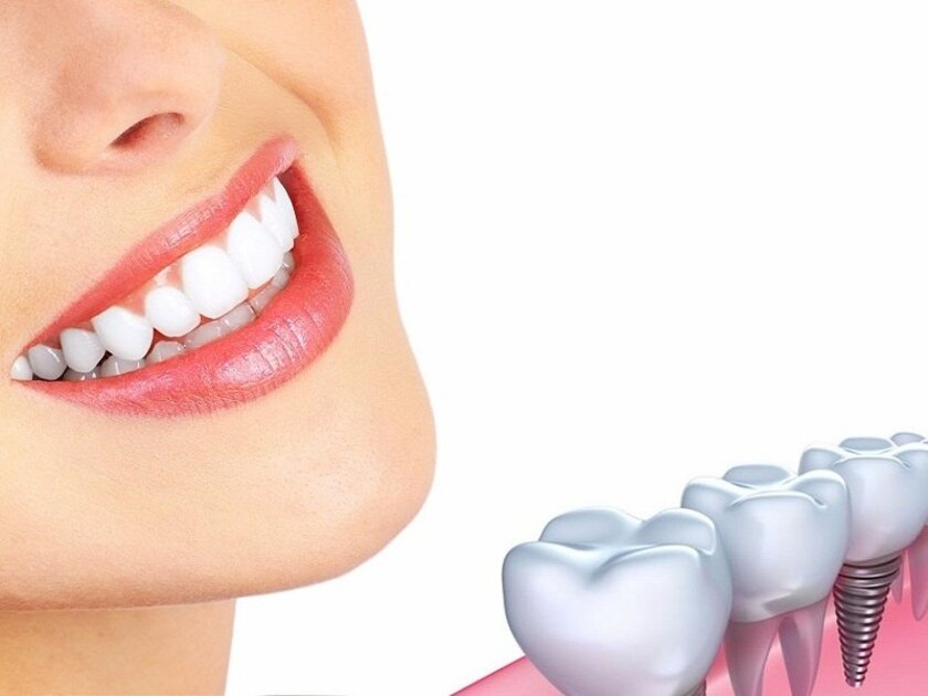 Trồng răng implant mang đến tính thẩm mỹ cao
