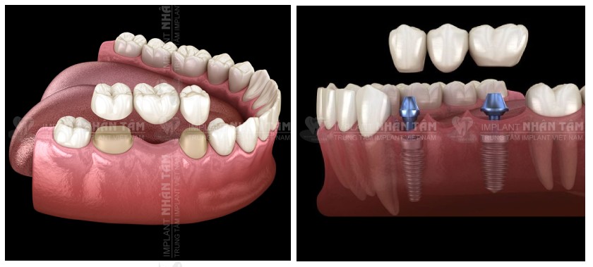 So sánh cầu răng sứ thông thường và cầu răng sứ trên Implant