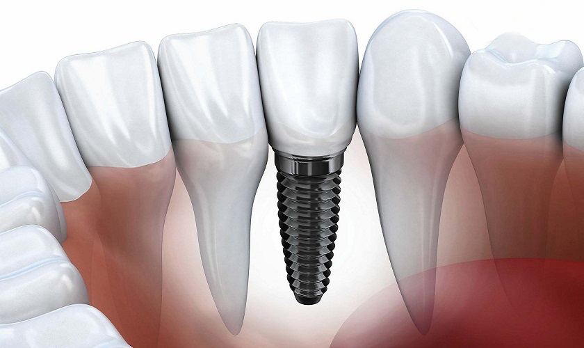 Trồng răng Implant hiện là kỹ thuật phục hồi răng được đánh giá rất cao cả về mặt thẩm mỹ và chức năng ăn nhai