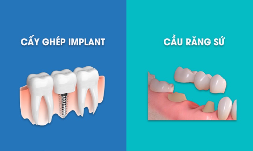So sánh cầu răng sứ và Implant – Nên chọn phương pháp nào?