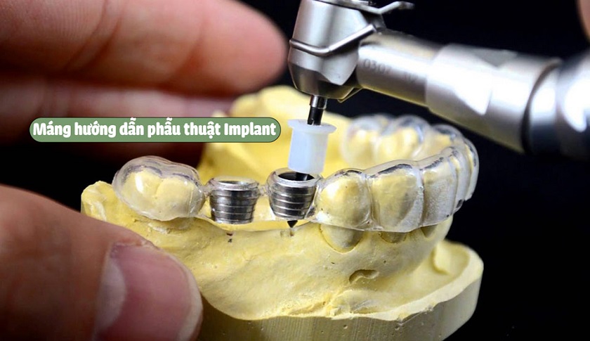 Máng hướng dẫn phẫu thuật trồng răng Implant trước đây