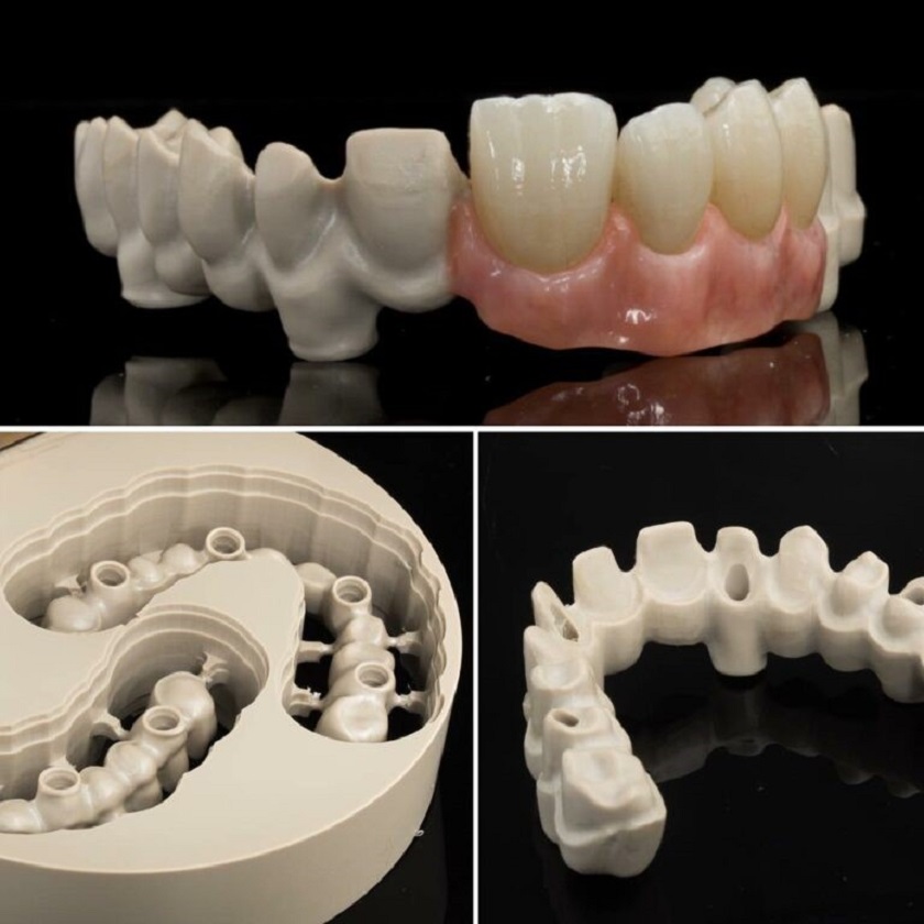 Sử dụng BioHPP cho phục hình trồng răng Implant tức thì