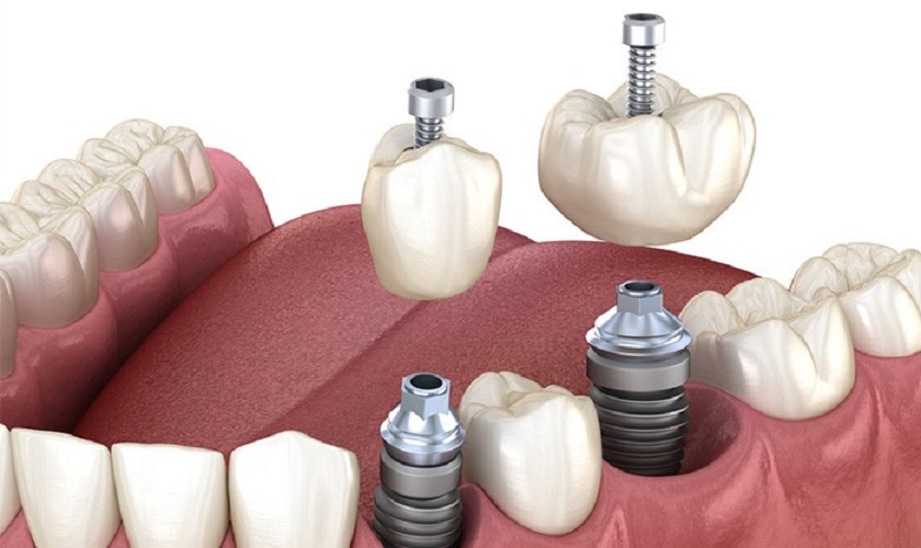 Sử dụng BioHPP phục hình trồng răng Implant có ưu điểm gì?