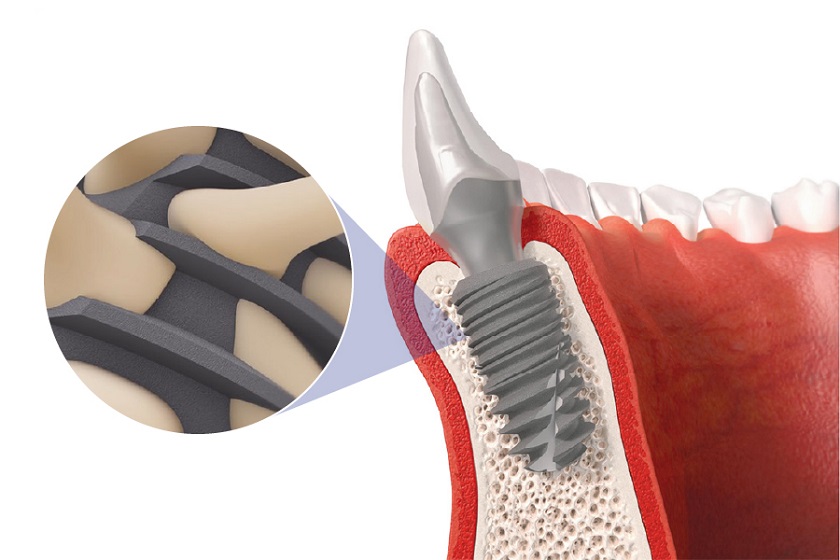 Sự khác nhau giữa các loại Implant đến từ khả năng tích hợp xương