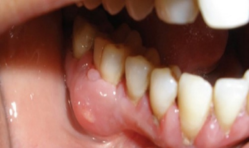 Sưng lợi răng hàm có thể xảy ra với bất kì đối tượng nào