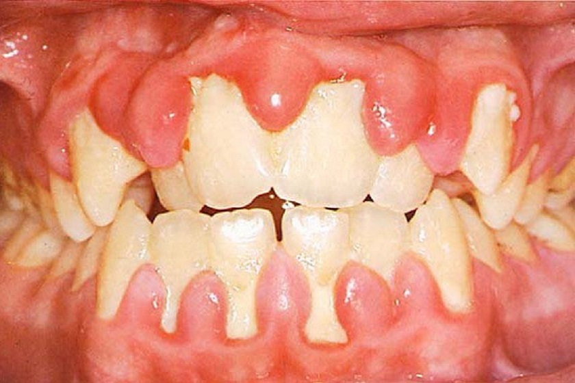 Bệnh viêm nướu răng với biểu hiện nướu bị sưng phồng