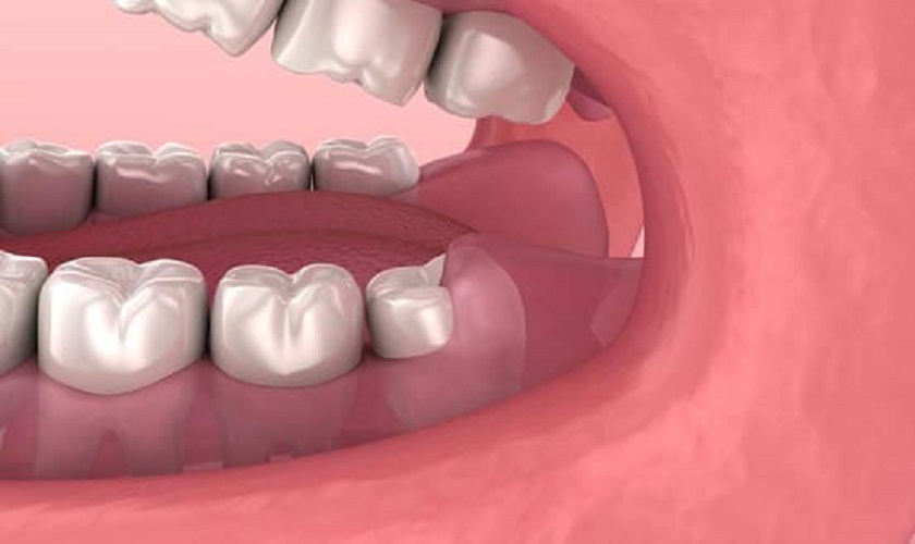 Sưng lợi răng hàm là gì? Nguyên nhân và cách điều trị