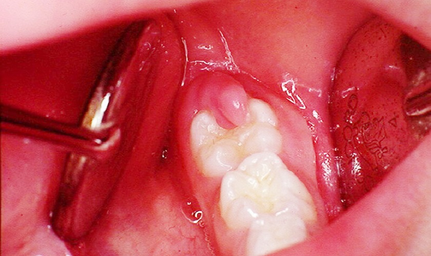 Mô nướu phồng to là triệu chứng điển hình của sưng nướu răng khôn
