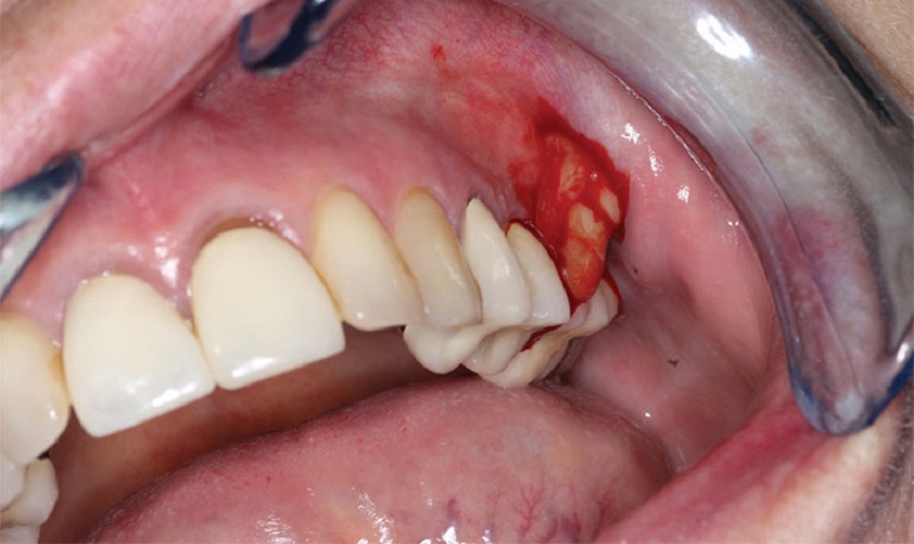 Sưng nướu răng khôn không được điều trị có thể dẫn đến viêm nướu răng có mủ
