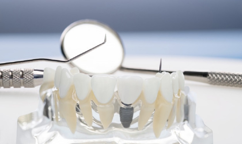 Tiêu chuẩn vô trùng trong trồng răng Implant cần đảm bảo