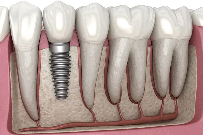 Sử dụng phương pháp trồng răng Implant để điều trị tiêu xương chân răng