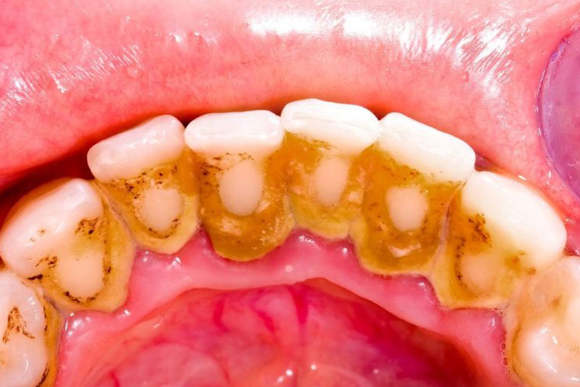 Vôi răng cũng là nguyên nhân dẫn đến tiêu xương chân răng