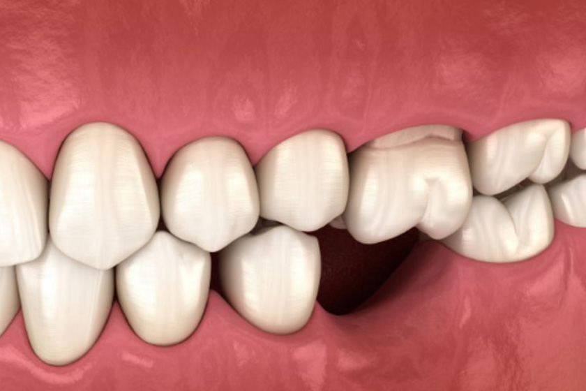 Mất răng lâu ngày là một trong những nguyên nhân gây tiêu xương chân răng