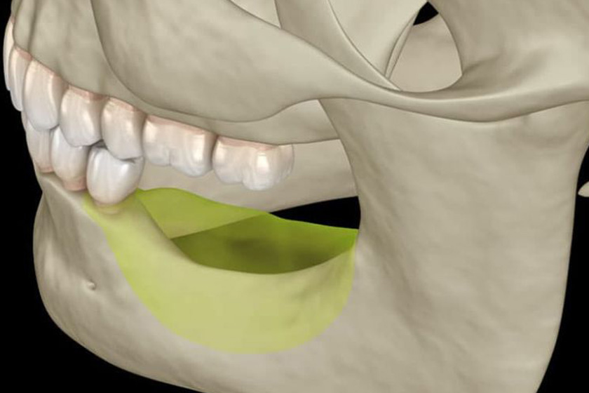 Tiêu xương chân răng có chữa được không?