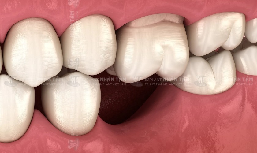Xương hàm sẽ bị tiêu đi khi mất răng