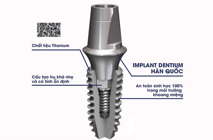 Cấu tạo của Implant Dentium Hàn Quốc